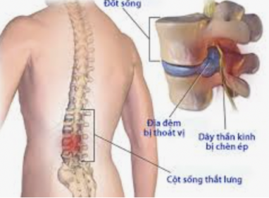 Các Bệnh Lý Về Cột Sống Cần Lưu Ý