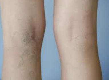 Suy Giãn Tĩnh Mạch những điều bạn cần biết