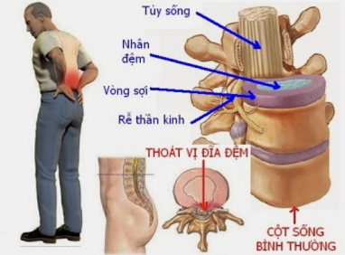 Sự Khác Biệt Giữa Thoát Vị Đĩa Đệm Và Thoái Hóa Đốt Sống: Giải Thích Nguyên Nhân, Triệu Chứng