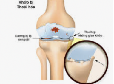 Bệnh Gai Khớp Gối: Nguyên Nhân – Triệu Chứng – Cách Điều Trị Hiệu Quả