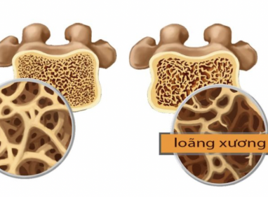 Những điều cần biết về loãng xương ở người cao tuổi