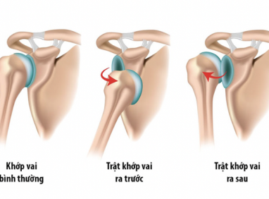 Trật Khớp Vai: Nguyên Nhân, Dấu Hiệu Và Cách Điều Trị Hiệu Quả