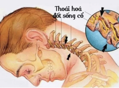 Thoái Hóa Đốt Sống Cổ Và Tê Tay Có Liên Quan Đến Nhau Không?