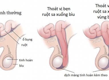 Bệnh Thoát Vị Bẹn Có Dễ Bị Mắc Phải Hay Không?