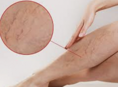 Bạn biết gì về bệnh suy giãn tĩnh mạch